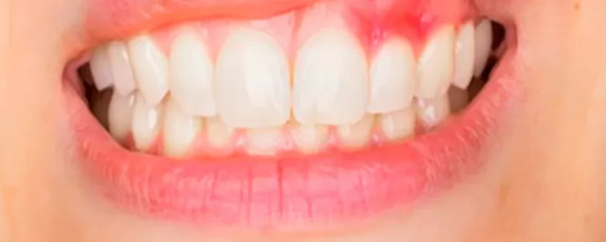 DİŞ ETİ HASTALIKLARI